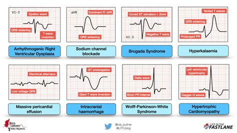 Understanding Abnormal EKG Results .